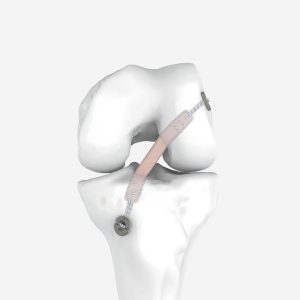 All-Inside Femoral Adjustable Button Loop